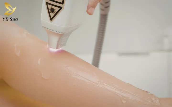So Sánh Các Công Nghệ Triệt Lông Vĩnh Viễn: Laser Diode, Ipl, Opt & Mới Nhất 2026