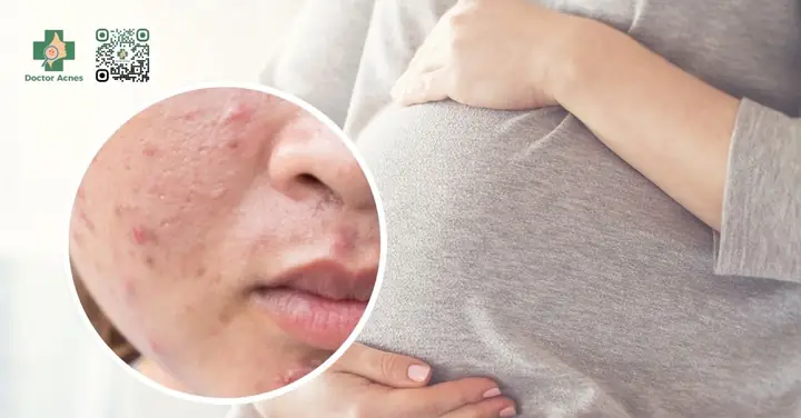 Chăm Sóc Da Mụn Cho Bà Bầu An Toàn Và Hiệu Quả: Hướng Dẫn Chi Tiết Từ Chuyên Gia