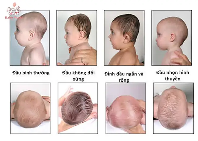 Cách Chữa Méo Đầu Trẻ Sơ Sinh Đúng Cách: Giải Pháp Toàn Diện Cho Cha Mẹ Cách Chữa Méo Đầu Trẻ Sơ Sinh Đúng Cách: Giải Pháp Toàn Diện Cho Cha Mẹ