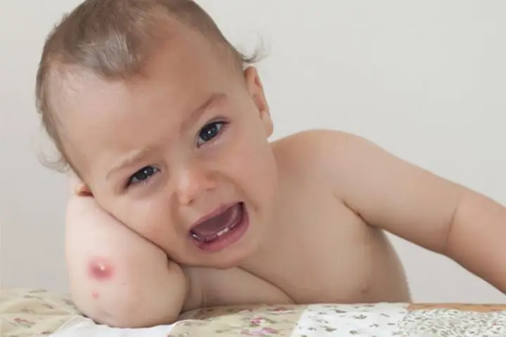 Cách Chữa Mụn Nhọt Cho Bé: Hướng Dẫn Chi Tiết Từ Chuyên Gia Nhi Khoa