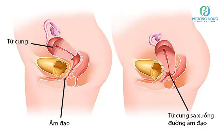Cách Giảm Đau Dạ Con Sau Sinh Thường An Toàn Và Hiệu Quả Nhất Cho Mẹ