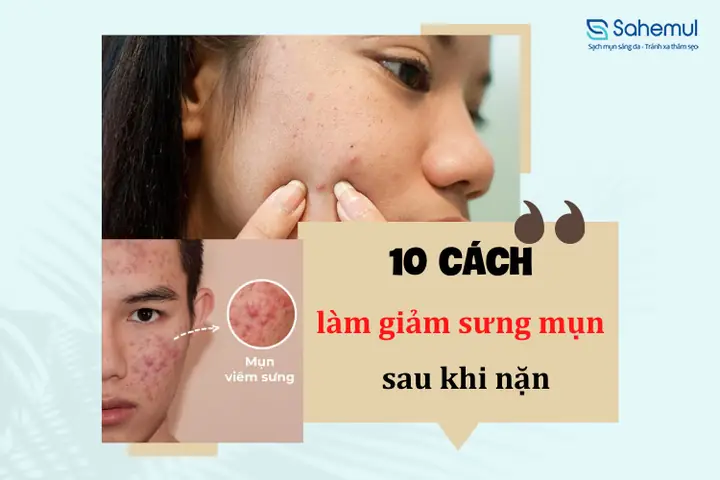 Cách Giảm Thâm Mụn Nhanh Chóng & An Toàn Sau Khi Nặn Mụn Cách Giảm Thâm Mụn Nhanh Chóng & An Toàn Sau Khi Nặn Mụn