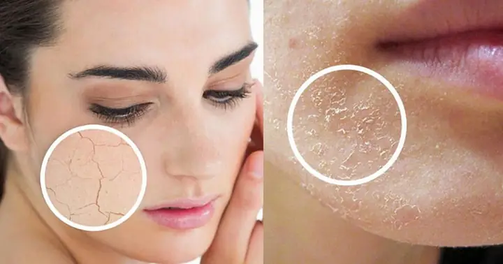Cách Làm Hết Tróc Da Mặt Hiệu Quả Tại Nhà, Giúp Da Mềm Mịn Trở Lại