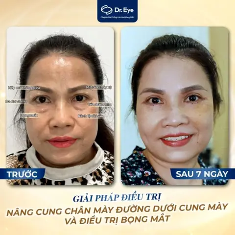 Mặt Nạ Xóa Nếp Nhăn Tự Nhiên: Bí Quyết Trẻ Hóa Làn Da Tại Nhà Hiệu Quả Mặt Nạ Xóa Nếp Nhăn Tự Nhiên: Bí Quyết Trẻ Hóa Làn Da Tại Nhà Hiệu Quả