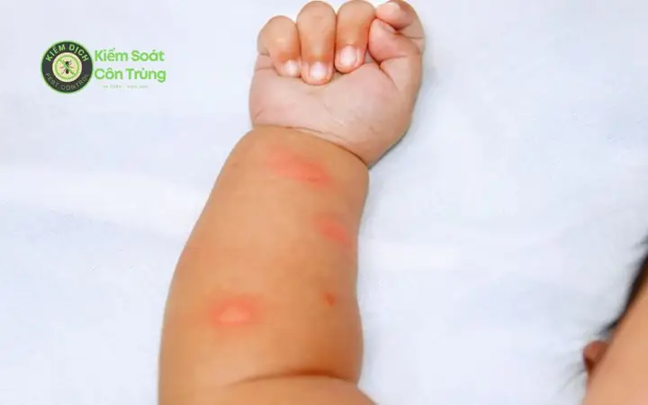 Cách Làm Tịt Nốt Muỗi Đốt Ở Trẻ Sơ Sinh: Bí Quyết Giảm Sưng, Ngứa Hiệu Quả & An Toàn Cách Làm Tịt Nốt Muỗi Đốt Ở Trẻ Sơ Sinh: Bí Quyết Giảm Sưng, Ngứa Hiệu Quả & An Toàn