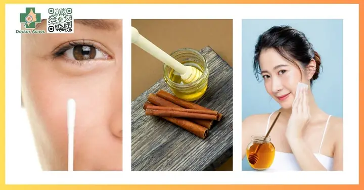 Cách Dùng Mật Ong Trị Mụn: Hướng Dẫn Toàn Diện Từ Chuyên Gia