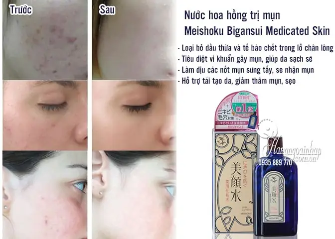 Cách Sử Dụng Nước Hoa Hồng Trị Mụn Nhật Bản Hiệu Quả Nhất: Hướng Dẫn Chi Tiết Từ A-z Cách Sử Dụng Nước Hoa Hồng Trị Mụn Nhật Bản Hiệu Quả Nhất: Hướng Dẫn Chi Tiết Từ A-z