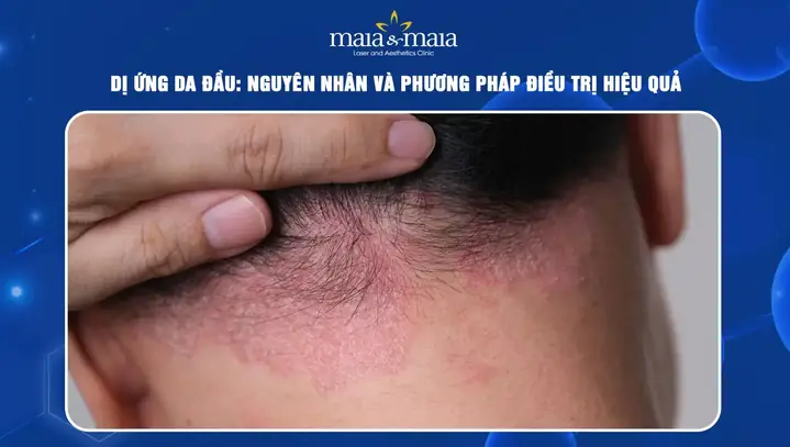 Cách Trị Dị Ứng Da Đầu Hiệu Quả: Nguyên Nhân, Dấu Hiệu & Giải Pháp Tự Nhiên