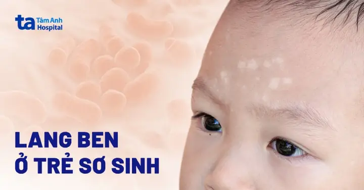 Cách Trị Lang Ben Cho Trẻ Sơ Sinh: An Toàn & Hiệu Quả Tại Nhà Cách Trị Lang Ben Cho Trẻ Sơ Sinh: An Toàn & Hiệu Quả Tại Nhà
