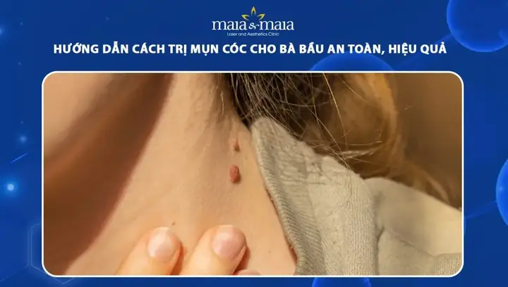 Cách Trị Mụn An Toàn & Hiệu Quả Cho Bà Bầu: Hướng Dẫn Chi Tiết Từ A-z Cách Trị Mụn An Toàn & Hiệu Quả Cho Bà Bầu: Hướng Dẫn Chi Tiết Từ A-z