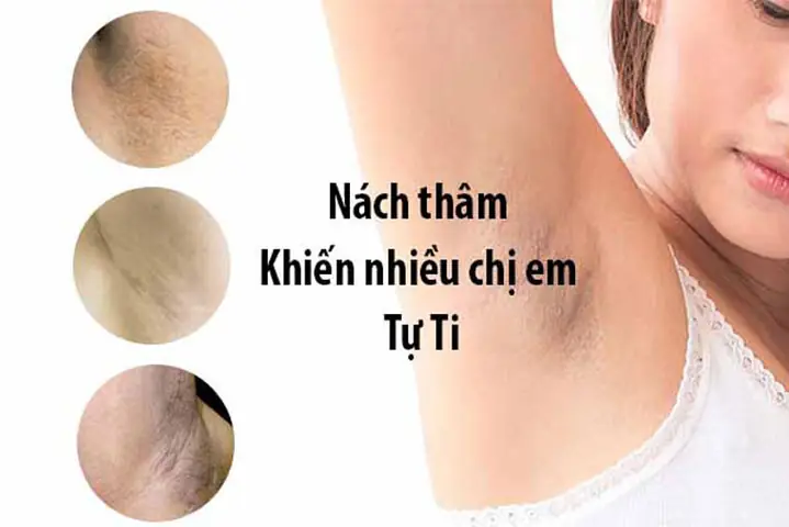 7+ Cách Trị Thâm Nách Tại Nhà Hiệu Quả, Tự Nhiên & An Toàn Nhất