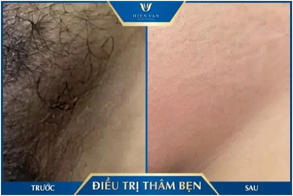 Bí Quyết Làm Hồng Vùng Kín: 10+ Cách Trị Thâm Hiệu Quả Tại Nhà Bí Quyết Làm Hồng Vùng Kín: 10+ Cách Trị Thâm Hiệu Quả Tại Nhà