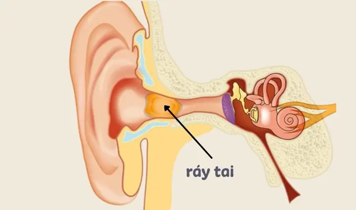 Cách Vệ Sinh Tai Bằng Nước Muối Sinh Lý Tại Nhà Đúng Cách & An Toàn Cách Vệ Sinh Tai Bằng Nước Muối Sinh Lý Tại Nhà Đúng Cách & An Toàn