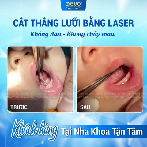 Cắt Thắng Lưỡi Cho Bé Bao Nhiêu Tiền? Bảng Giá Chi Tiết & Địa Chỉ Uy Tín Cắt Thắng Lưỡi Cho Bé Bao Nhiêu Tiền? Bảng Giá Chi Tiết & Địa Chỉ Uy Tín