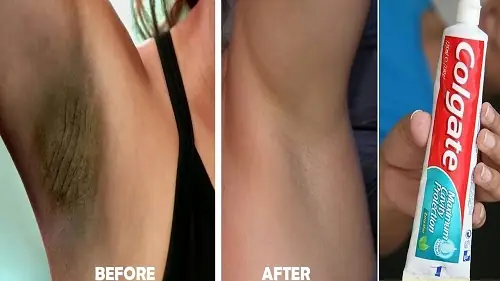 Chữa Hôi Nách Bằng Kem Đánh Răng: Bí Quyết Đơn Giản, Hiệu Quả Tức Thì Tại Nhà Chữa Hôi Nách Bằng Kem Đánh Răng: Bí Quyết Đơn Giản, Hiệu Quả Tức Thì Tại Nhà