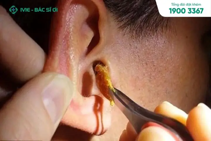 Có Nên Lấy Ráy Tai Cho Trẻ Không? Hướng Dẫn Chăm Sóc Tai An Toàn Cho Bé
