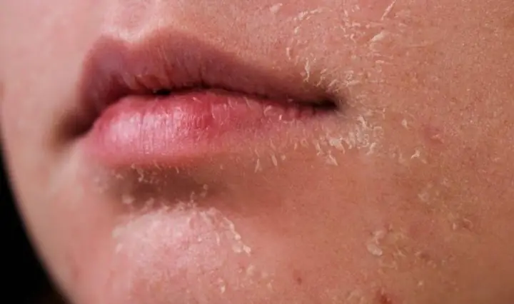 Da Bị Khô Tróc Vảy Phải Làm Sao? Nguyên Nhân & Cách Chăm Sóc Hiệu Quả