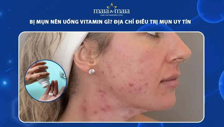 Da Bị Mụn Nên Uống Vitamin Gì? Vitamin & Khoáng Chất Hỗ Trợ Trị Mụn Hiệu Quả