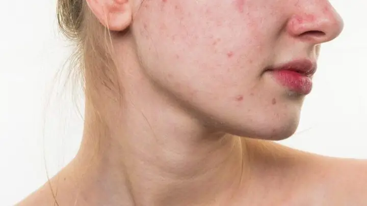 Da Khô Có Nên Tẩy Da Chết Không? Hướng Dẫn Chi Tiết & Lưu Ý Từ Chuyên Gia