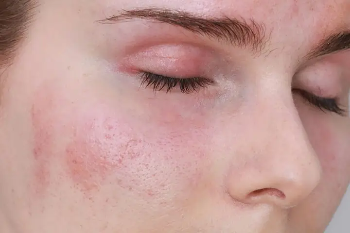 Da Mặt Bị Rát Khi Rửa Mặt: Nguyên Nhân, Cách Khắc Phục & Lời Khuyên Chuyên Gia