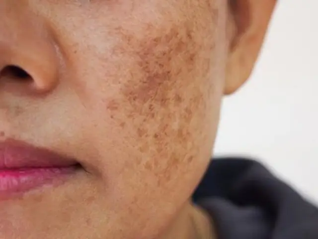 Da Mặt Bị Sạm Đen: Nguyên Nhân, Cách Khắc Phục Và Phòng Ngừa Hiệu Quả Da Mặt Bị Sạm Đen: Nguyên Nhân, Cách Khắc Phục Và Phòng Ngừa Hiệu Quả