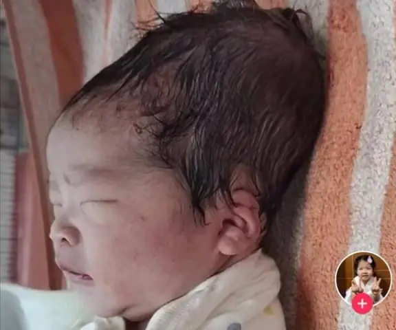 Đầu Em Bé Sơ Sinh Bị Dài: Nguyên Nhân, Ảnh Hưởng Và Cách Xử Lý Toàn Diện Đầu Em Bé Sơ Sinh Bị Dài: Nguyên Nhân, Ảnh Hưởng Và Cách Xử Lý Toàn Diện