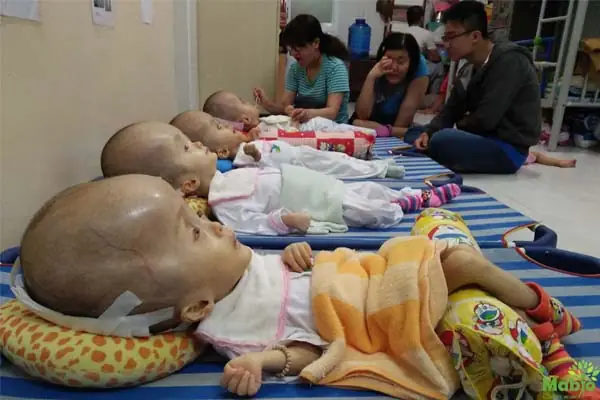 Đầu Em Bé Sơ Sinh Bị Dài: Nguyên Nhân, Ảnh Hưởng Và Cách Xử Lý Toàn Diện Đầu Em Bé Sơ Sinh Bị Dài: Nguyên Nhân, Ảnh Hưởng Và Cách Xử Lý Toàn Diện