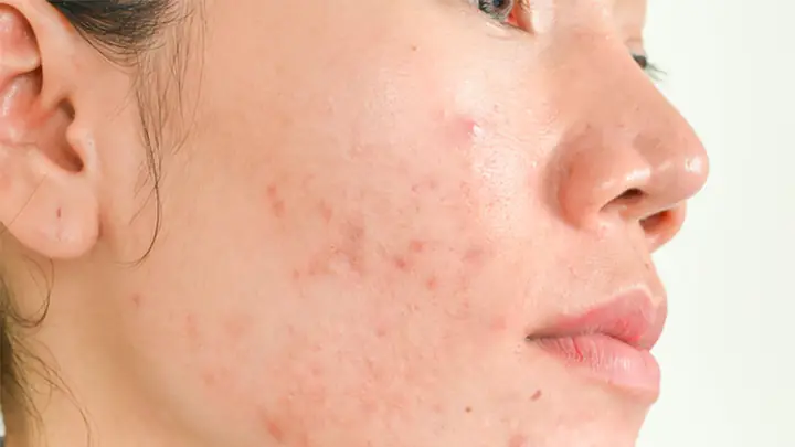 Dấu Hiệu Nhận Biết Da Không Hợp Mỹ Phẩm & Cách Xử Lý Kịp Thời