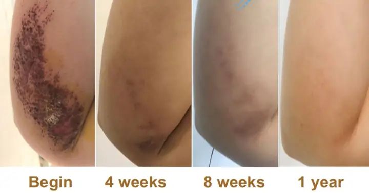 Dầu Mù U Trị Bỏng Bô Hiệu Quả: Cách Sử Dụng An Toàn Và Lành Thương Nhanh Chóng