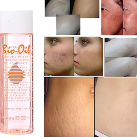 Dầu Bio Oil Trị Rạn Da Có Tốt Không? Review Chi Tiết Công Dụng & Cách Dùng