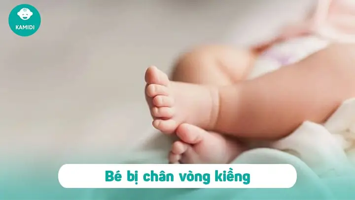 Đóng Bỉm Cho Trẻ Sơ Sinh Có Bị Vòng Kiềng Không? Sự Thật Và Cách Chăm Sóc Đúng Đóng Bỉm Cho Trẻ Sơ Sinh Có Bị Vòng Kiềng Không? Sự Thật Và Cách Chăm Sóc Đúng