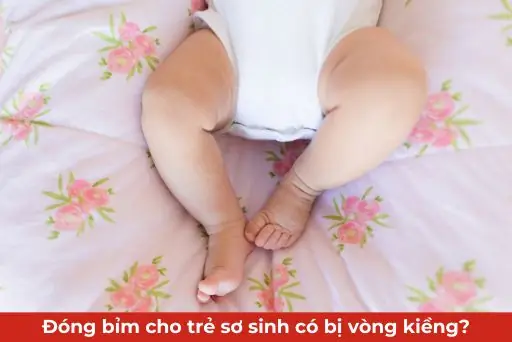 Đóng Bỉm Cho Trẻ Sơ Sinh Có Bị Vòng Kiềng Không? Sự Thật Và Cách Chăm Sóc Đúng Đóng Bỉm Cho Trẻ Sơ Sinh Có Bị Vòng Kiềng Không? Sự Thật Và Cách Chăm Sóc Đúng