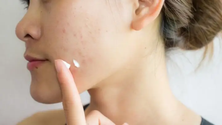 Dùng Kem Dưỡng Da Bị Nổi Mụn: Nguyên Nhân & Cách Khắc Phục Hiệu Quả