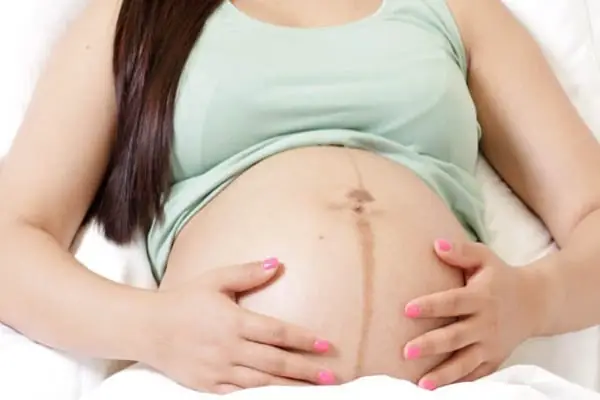 Vạch Nâu Ở Bụng Khi Mang Thai: Nguyên Nhân, Ý Nghĩa Và Cách Xử Lý Dứt Điểm