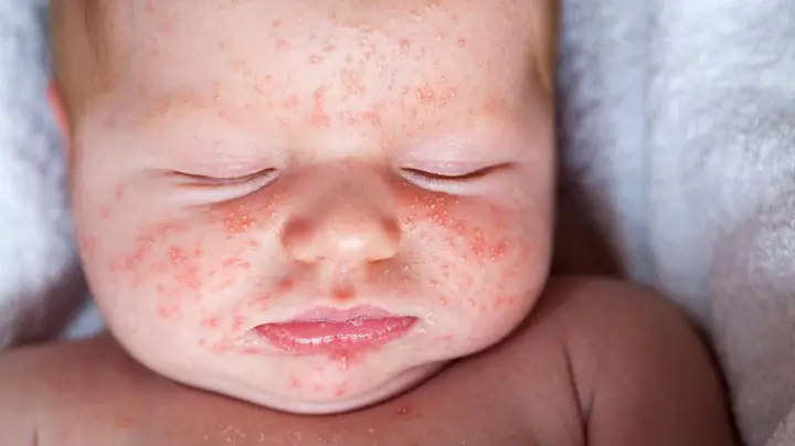 Em Bé Nổi Mẩn Đỏ Trên Mặt: Nguyên Nhân, Dấu Hiệu Và Cách Chăm Sóc An Toàn Tại Nhà Em Bé Nổi Mẩn Đỏ Trên Mặt: Nguyên Nhân, Dấu Hiệu Và Cách Chăm Sóc An Toàn Tại Nhà