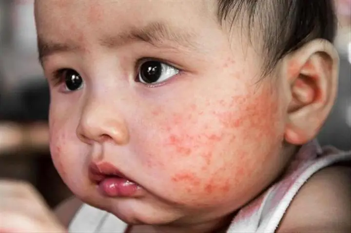 Em Bé Nổi Mẩn Đỏ Trên Mặt: Nguyên Nhân, Dấu Hiệu Và Cách Chăm Sóc An Toàn Tại Nhà Em Bé Nổi Mẩn Đỏ Trên Mặt: Nguyên Nhân, Dấu Hiệu Và Cách Chăm Sóc An Toàn Tại Nhà