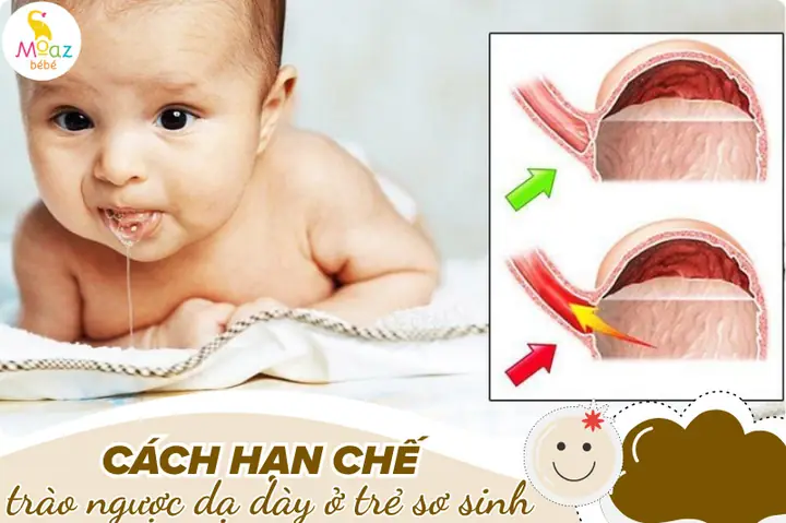 Khi Nào Dạ Dày Trẻ Sơ Sinh Hết Nằm Ngang Để Giảm Trớ?