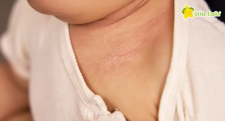 Khô Da Ở Trẻ Sơ Sinh: Nguyên Nhân, Cách Chăm Sóc Và Dấu Hiệu Cần Gặp Bác Sĩ