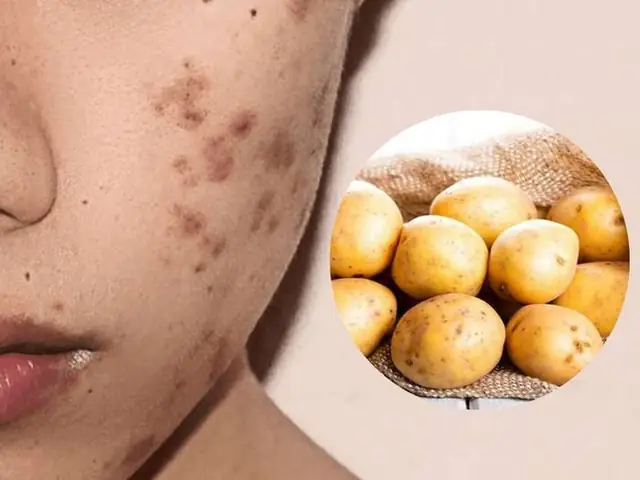 Mặt Nạ Khoai Tây Trị Mụn: Công Thức & Cách Làm Hiệu Quả Tại Nhà