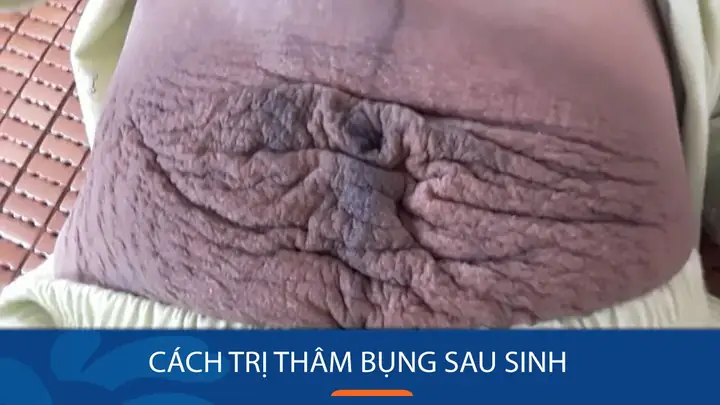 Làm Mờ Vết Thâm Sau Sinh: Bí Quyết Trị Thâm Bụng, Nách An Toàn, Hiệu Quả Cho Mẹ Bỉm Làm Mờ Vết Thâm Sau Sinh: Bí Quyết Trị Thâm Bụng, Nách An Toàn, Hiệu Quả Cho Mẹ Bỉm