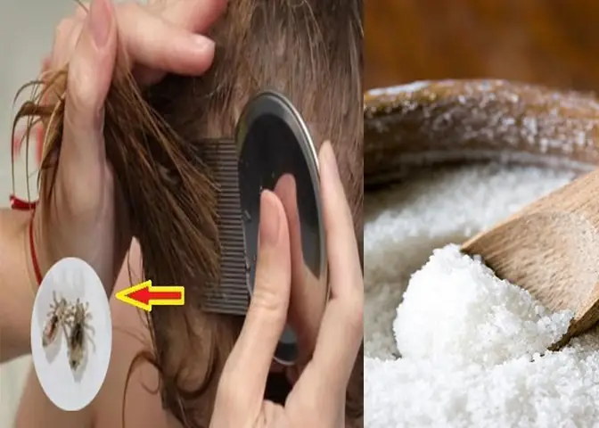 Hết Chấy Nhanh Nhất: 9+ Cách Trị Chấy & Trứng Chấy An Toàn, Hiệu Quả Tại Nhà Hết Chấy Nhanh Nhất: 9+ Cách Trị Chấy & Trứng Chấy An Toàn, Hiệu Quả Tại Nhà