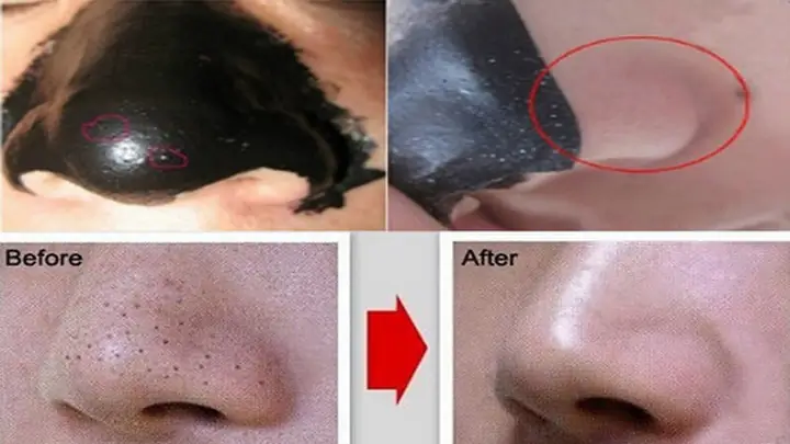 Lột Mụn Đầu Đen Ở Mũi Đúng Cách: Bí Quyết Loại Bỏ Tận Gốc & Ngăn Ngừa Tái Phát