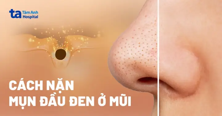 Lột Mụn Đầu Đen Ở Mũi Đúng Cách: Bí Quyết Loại Bỏ Tận Gốc & Ngăn Ngừa Tái Phát