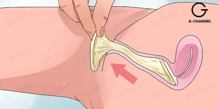 Dùng Bao Cao Su Vẫn Dính Bầu: Nguyên Nhân & Cách Phòng Tránh Tối Đa