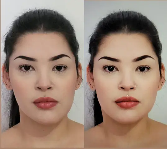 Mặt Bị Chảy Xệ Một Bên: Nguyên Nhân, Cách Khắc Phục Toàn Diện & Phòng Ngừa Hiệu Quả