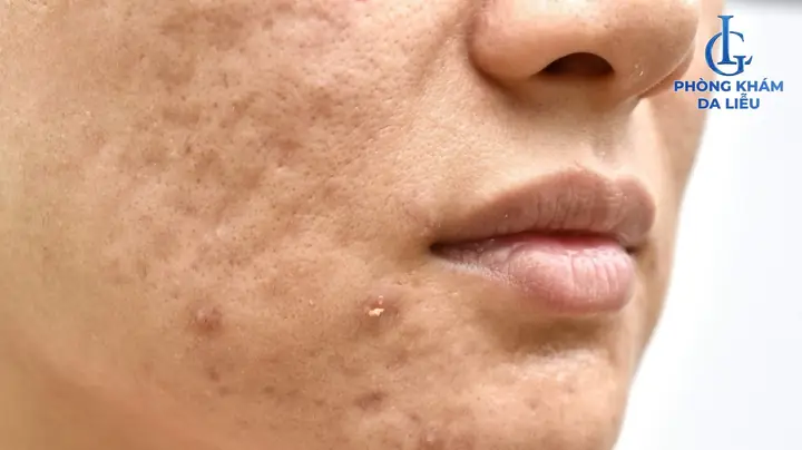 Mặt Nạ Trị Sẹo Rỗ Lâu Năm: Công Thức Thiên Nhiên Hiệu Quả Tại Nhà