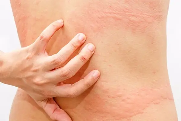 Mẹo Trị Mề Đay Cho Bà Bầu An Toàn, Hiệu Quả Tại Nhà Mẹo Trị Mề Đay Cho Bà Bầu An Toàn, Hiệu Quả Tại Nhà