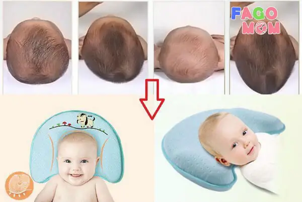 9+ Mẹo Trị Méo Đầu Cho Trẻ Sơ Sinh Hiệu Quả Và Dấu Hiệu Cần Đi Khám