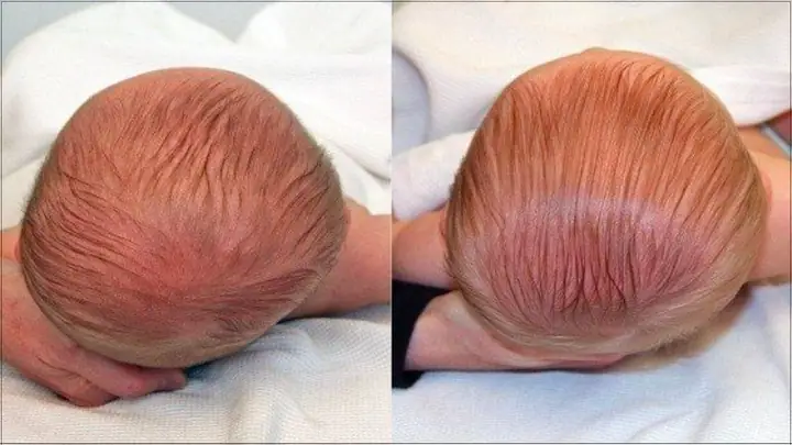 9+ Mẹo Trị Méo Đầu Cho Trẻ Sơ Sinh Hiệu Quả Và Dấu Hiệu Cần Đi Khám