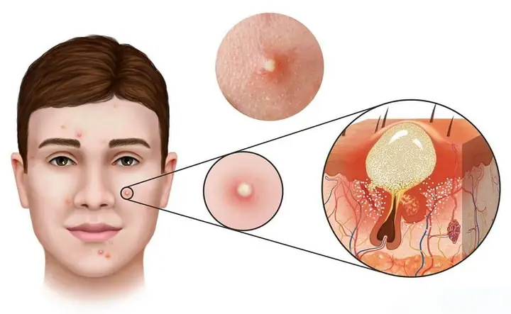 Miếng Dán Mụn Có Tốt Không? Sự Thật Về Hiệu Quả Và Cách Sử Dụng Đúng Miếng Dán Mụn Có Tốt Không? Sự Thật Về Hiệu Quả Và Cách Sử Dụng Đúng